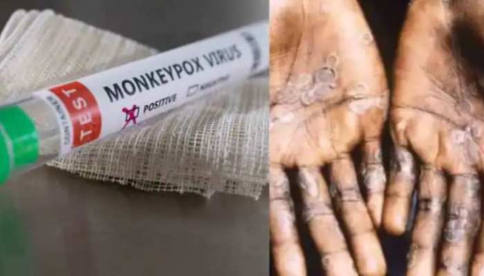 Monkeypox Vaccine: आदार पूनावाला ने बताया, भारत में कब तक आएगी मंकीपॉक्स की वैक्सीन