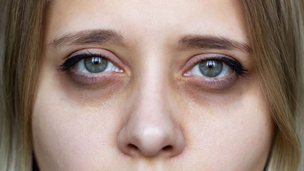 Dark Circles Not Just About Sleep: Experts Highlight Six Key Causes and Targeted Treatments